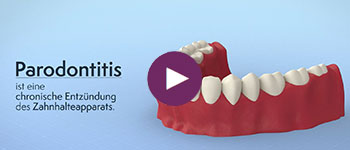 Parodontitis-Behandlung